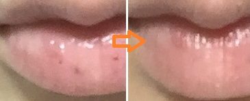 セルフケアでは消えない唇のシミ。東京都内のレーザー治療がおすすめです