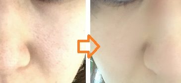 鼻や顔の黒い毛穴の開きをなくす方法 レーザーで改善治療画像
