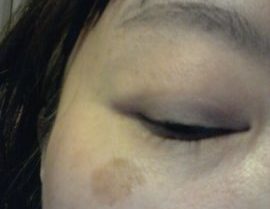 紫外線で40代でもシミだらけ！老人性の顔のシミを消す皮膚科探し
